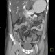 Thrombosis of superior mesenteric vein, infarsation of small bowel: CT - Computed tomography